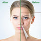 BREYLEE Acne Pimple Patch Acne Treatment Serum Face Sheet Mask Facial Acne Cream Essence Facial Skin Care Pimple Remover Tools