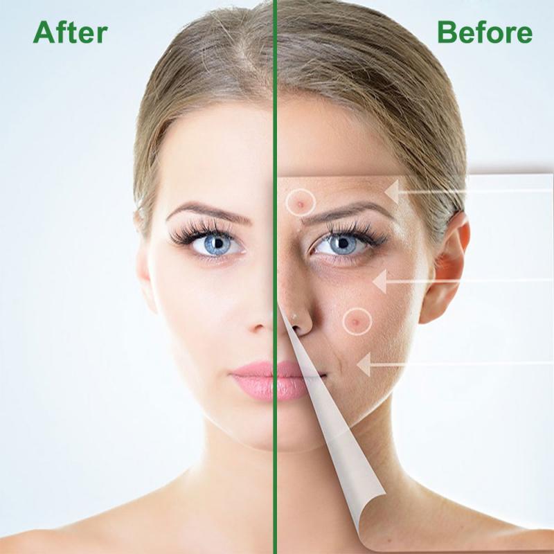 BREYLEE Acne Pimple Patch Acne Treatment Serum Face Sheet Mask Facial Acne Cream Essence Facial Skin Care Pimple Remover Tools